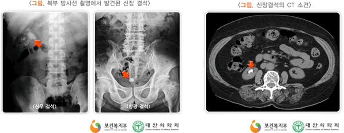 그림 복부 방사선 촬영에서 발견된 신장 결석